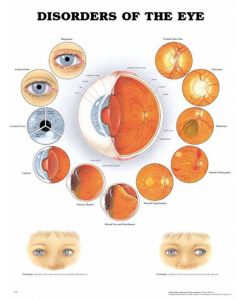 Disorders Of The Eye Diagram - 20" x 26"